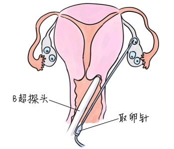 小儿退烧推拿手法 5种惠州捐卵宝宝退烧按摩方法